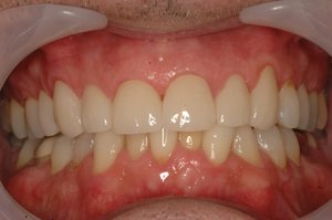 teeth to obtain more clearance and gain height, selectively place fillings on the tops of the left and right back teeth