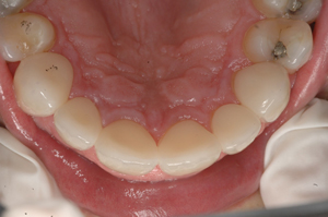 Post Op: Dental Crowns, Bonding, and tooth colored fillings