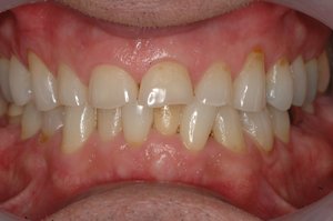 Pre op: heavy hard bite resulting in wearing upper front teeth through the enamel into the dentin