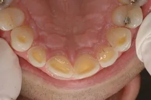Patient presents with heavy wear