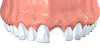 Knocked Out Tooth (Avulsed tooth)