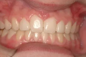 After orthodontics