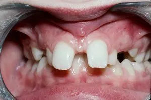 Before orthodontics