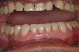 Post-Op Mandibular Arch Gilroy Smiles