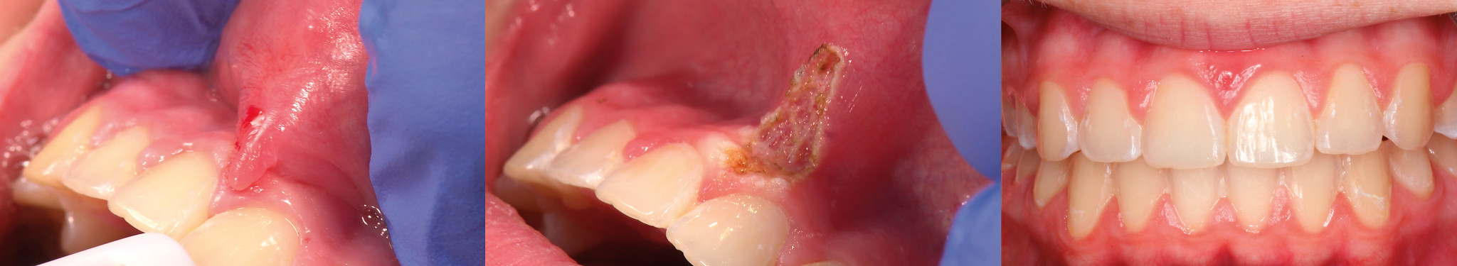 Before and after laser frenectomy