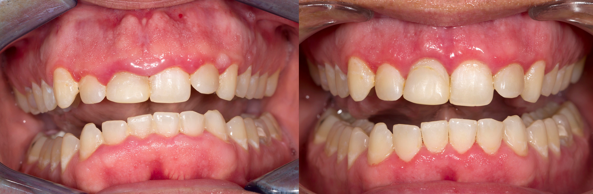 Before and after gingivectomy