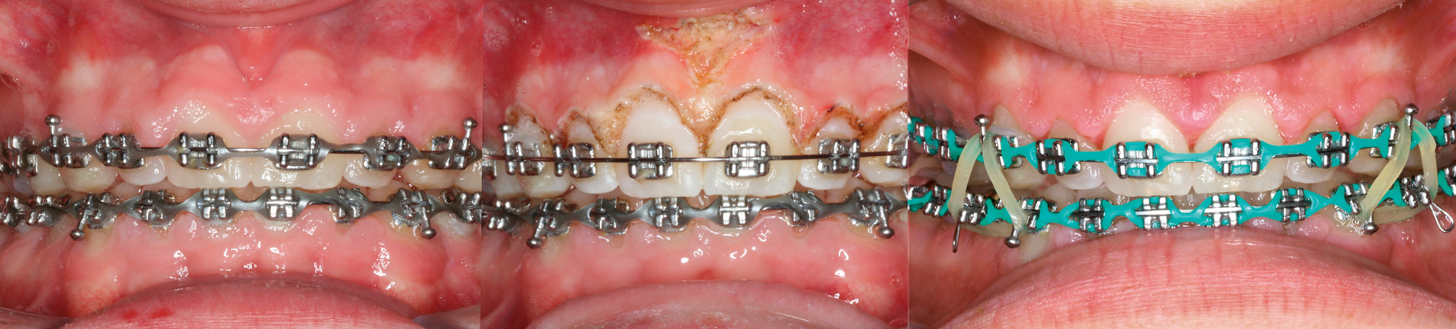 Before and after gingivectomy on patient with braces
